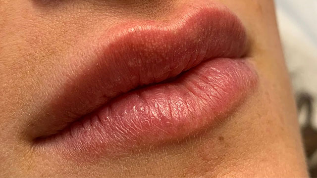 Dermal Fillers Lips